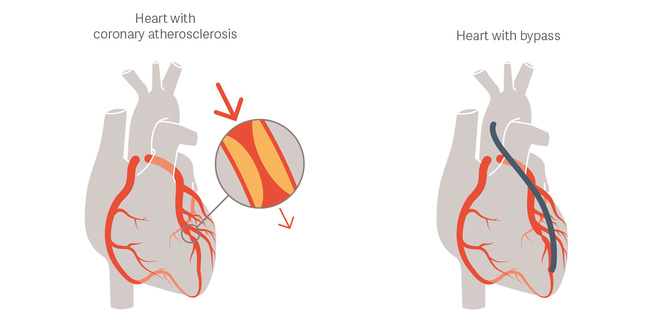 CABG (Koroner Arter Bypass Grefti)